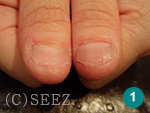 爪噛みに多くみられる親指。爪周りの皮膚が荒れて危機的状況です